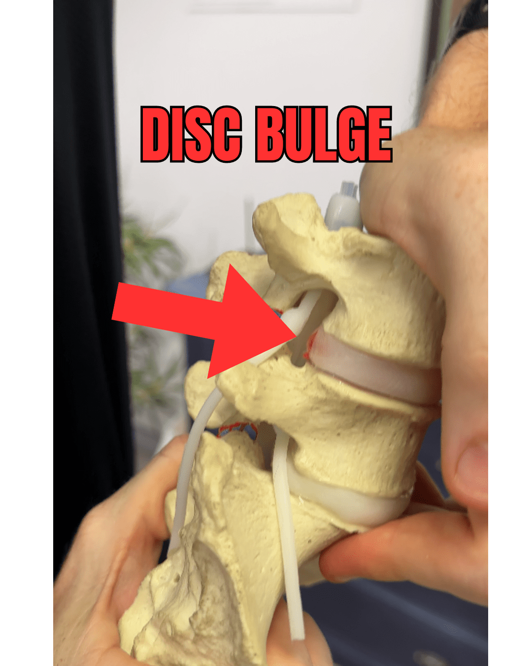 Disc Bulge Rehab - Perth Injury & Pain Clinic