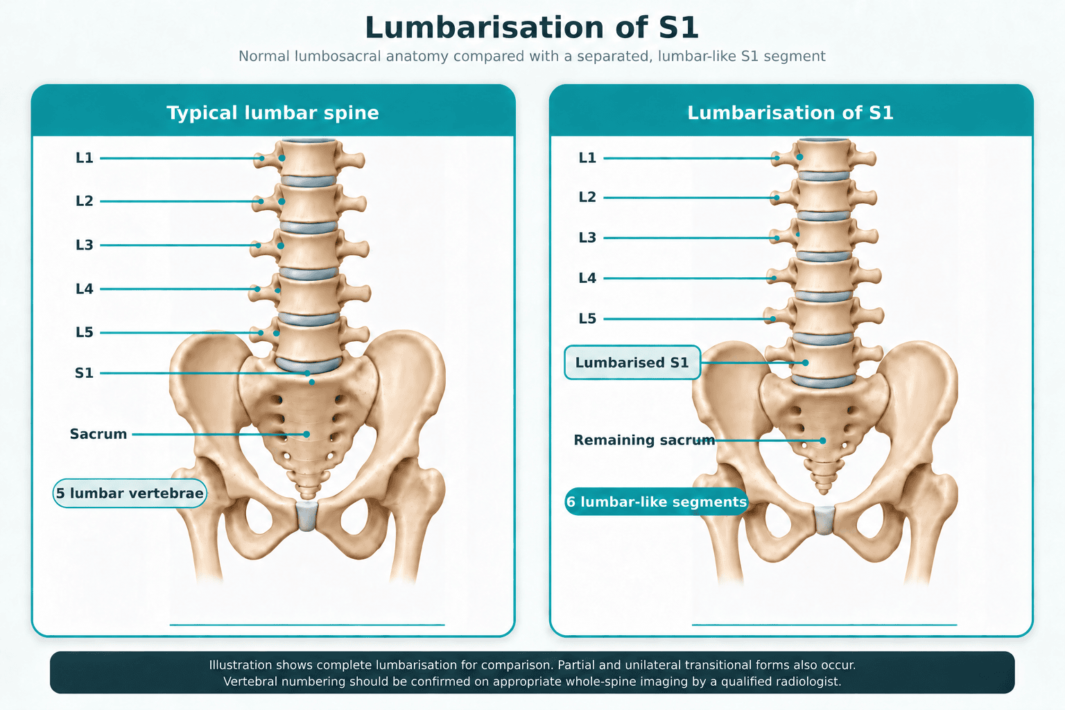 Side-by-side illustration comparing a typical lumbar spine with lumbarisation of S1, with each vertebral level labelled